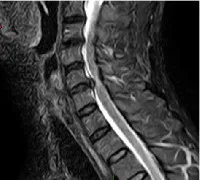herniecervical