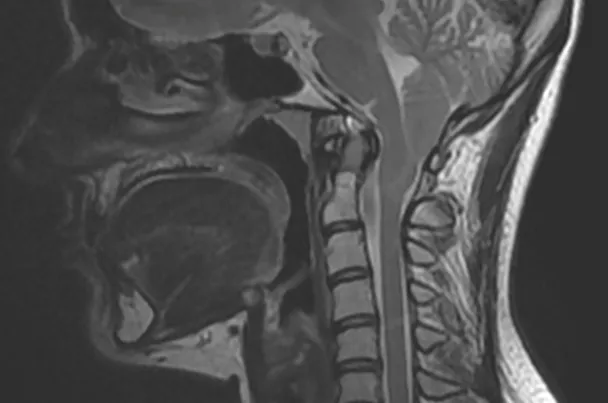 MALFORMATION DE CHIARI
