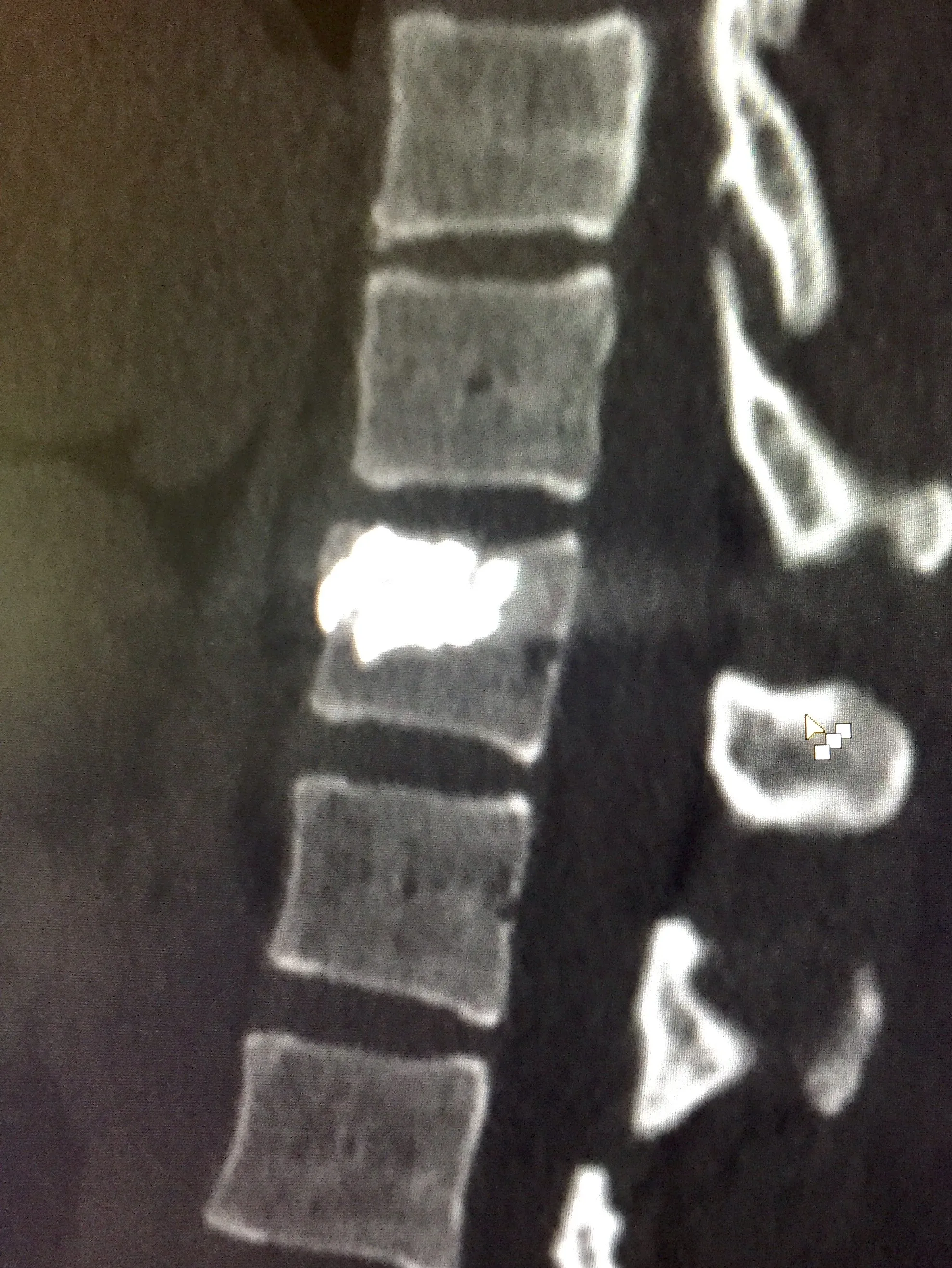 SpineJack3